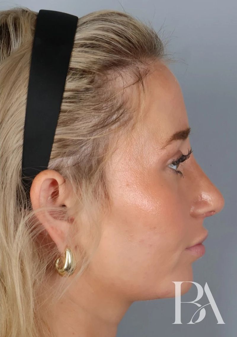 After — Rhinoplasty