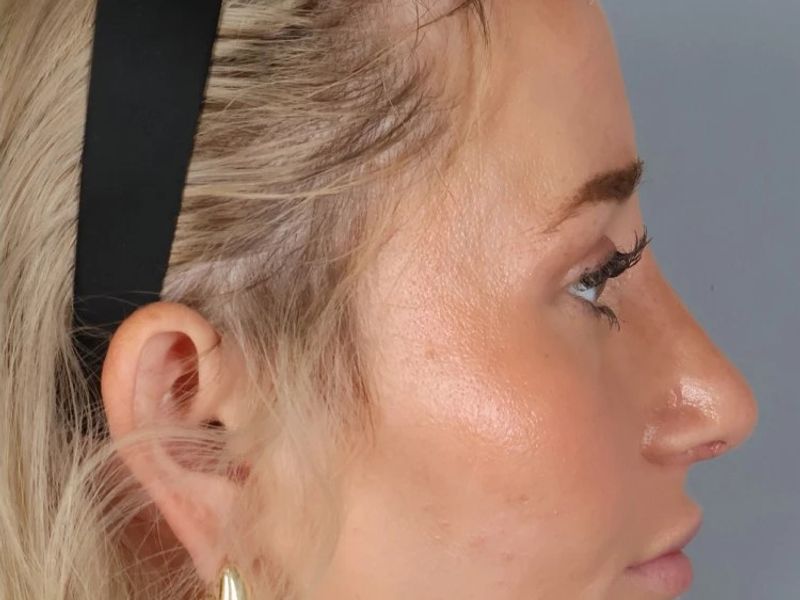 After — Rhinoplasty