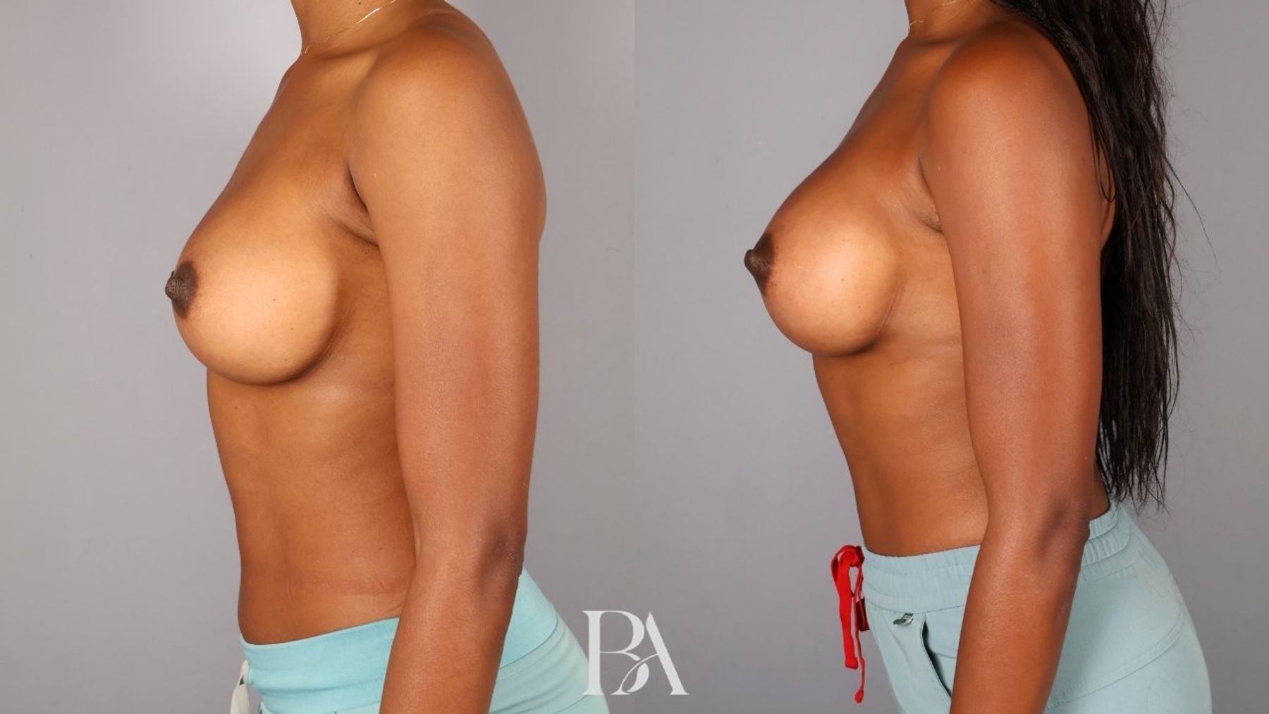 Implant Removal and Replacement before and after — side view, Dr. Beina Azadgoli, Beverly Hills