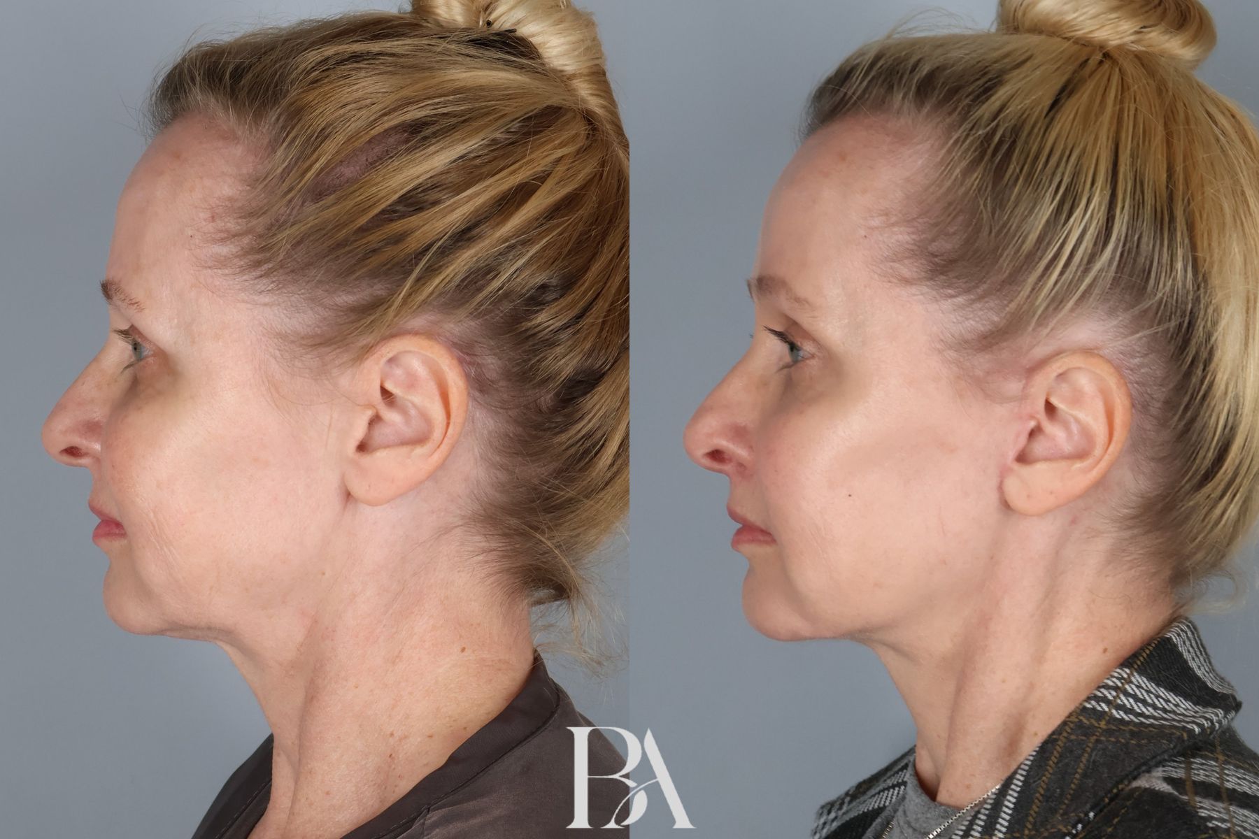 Face/Neck Lift before and after — side view, Dr. Beina Azadgoli, Beverly Hills