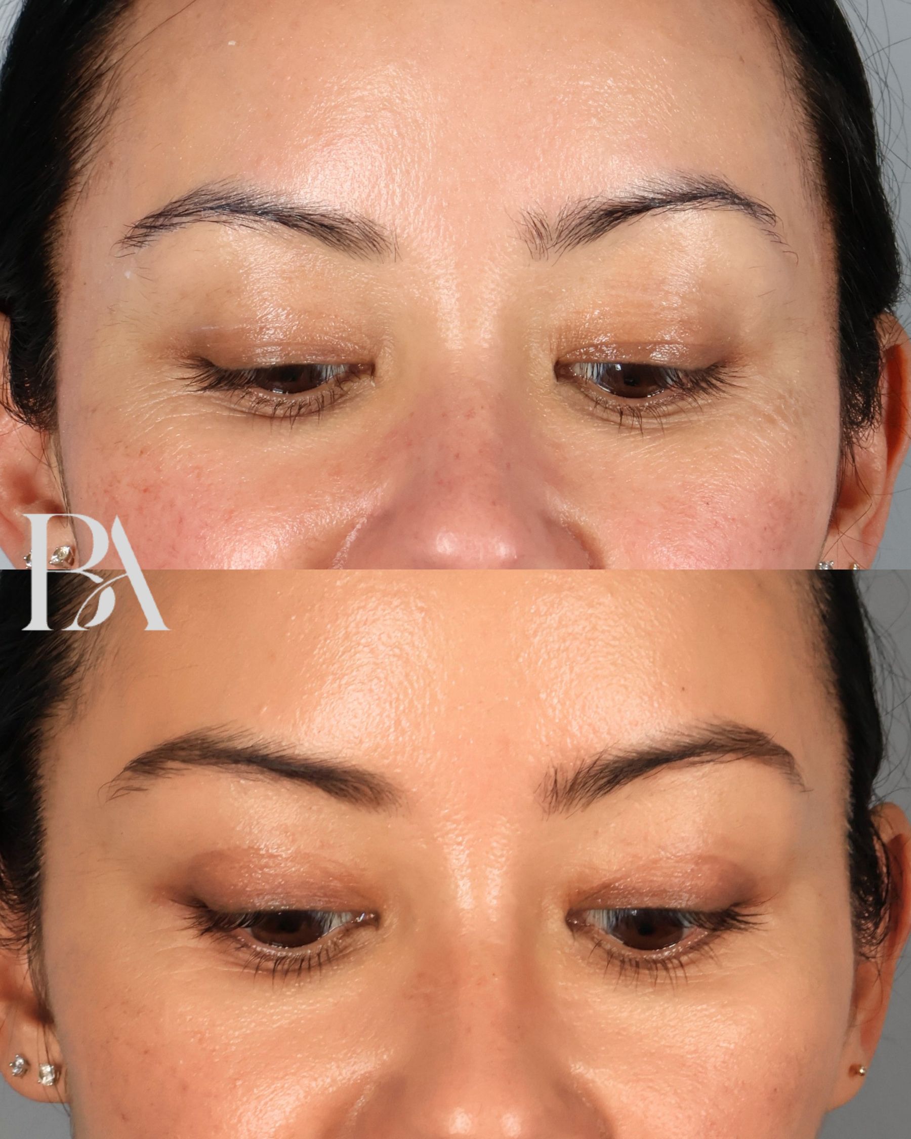 Upper Blepharoplasty before and after — detail view, Dr. Beina Azadgoli, Beverly Hills