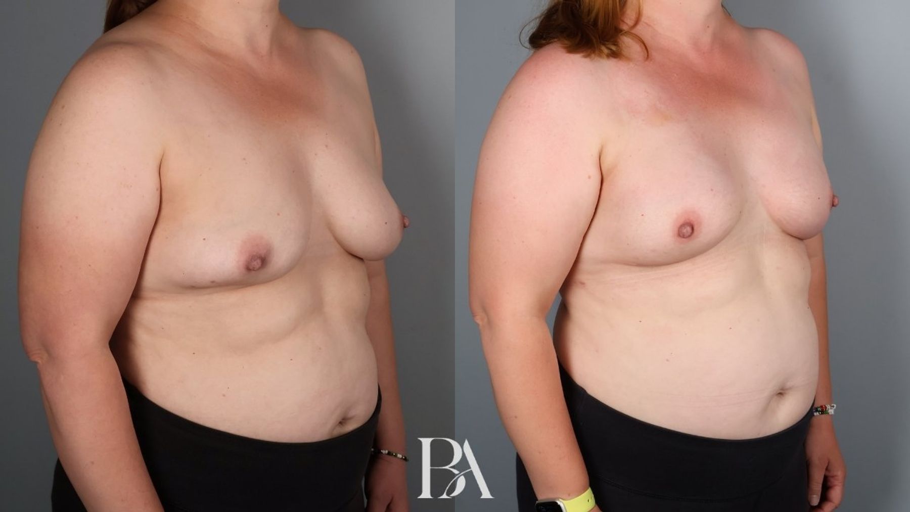 Direct-to-Implant Reconstruction before and after — oblique view, Dr. Beina Azadgoli, Beverly Hills