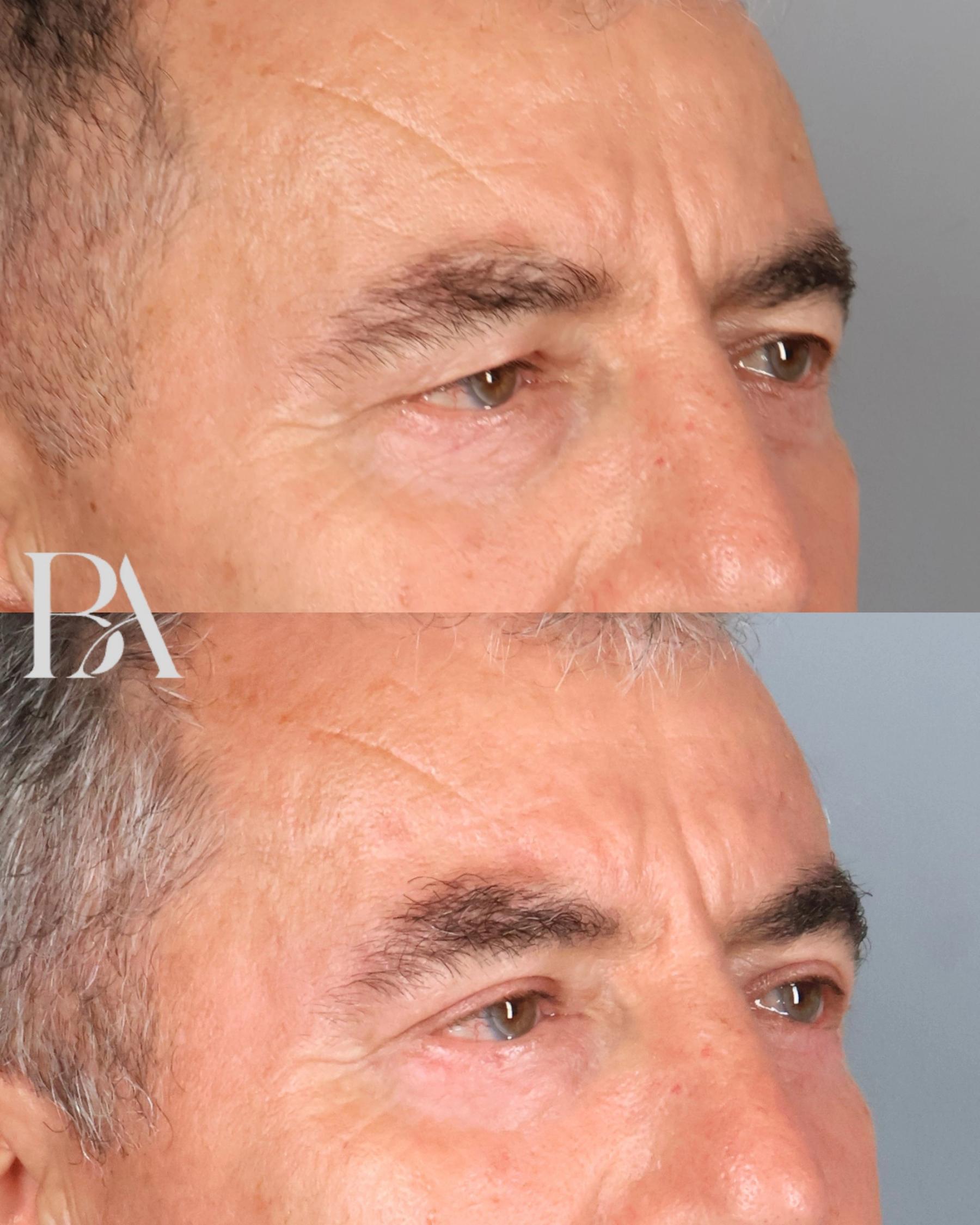 Upper Blepharoplasty before and after — oblique view, Dr. Beina Azadgoli, Beverly Hills
