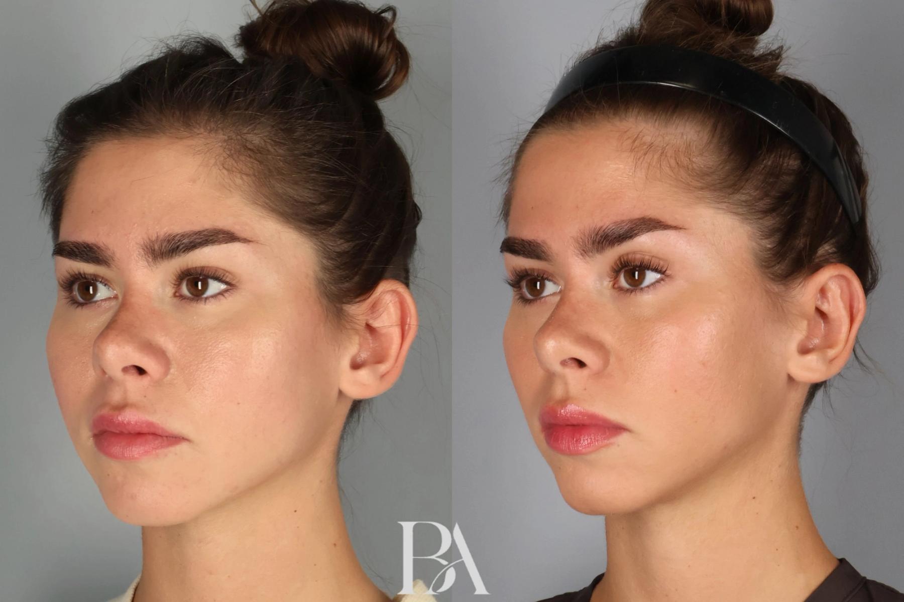 Ear Pinning before and after — oblique view, Dr. Beina Azadgoli, Beverly Hills