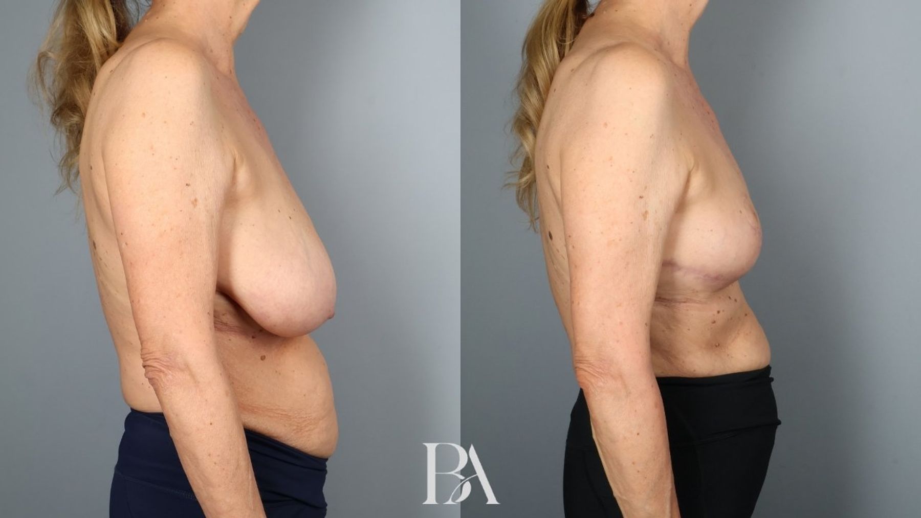 Breast reduction before and after — side view, Dr. Beina Azadgoli, Beverly Hills