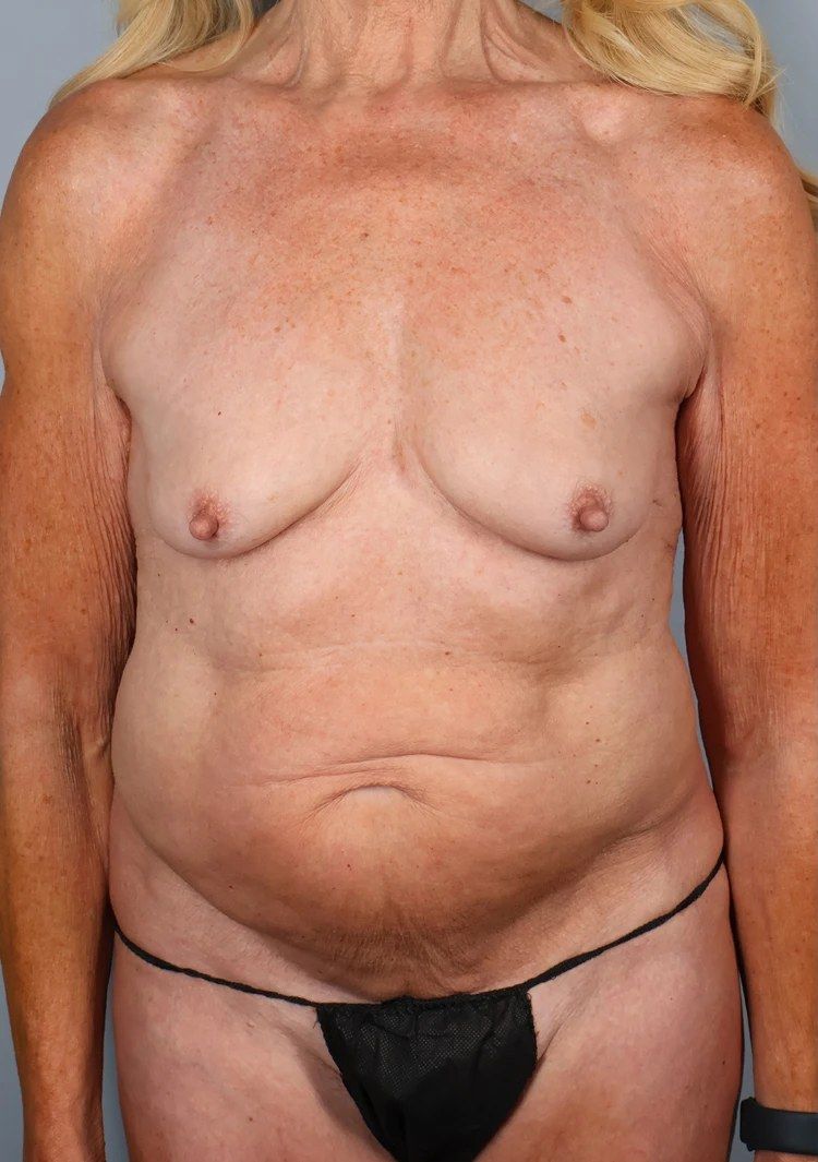 Before — Tummy Tuck (Abdominoplasty)