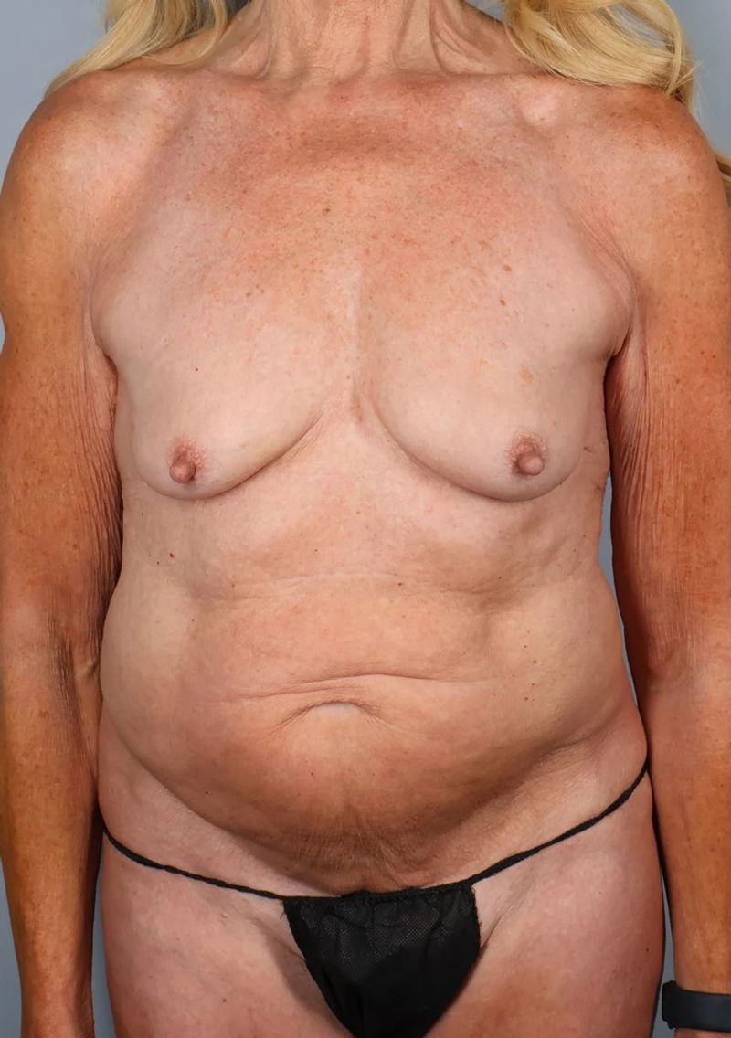 Before — Tummy Tuck (Abdominoplasty)