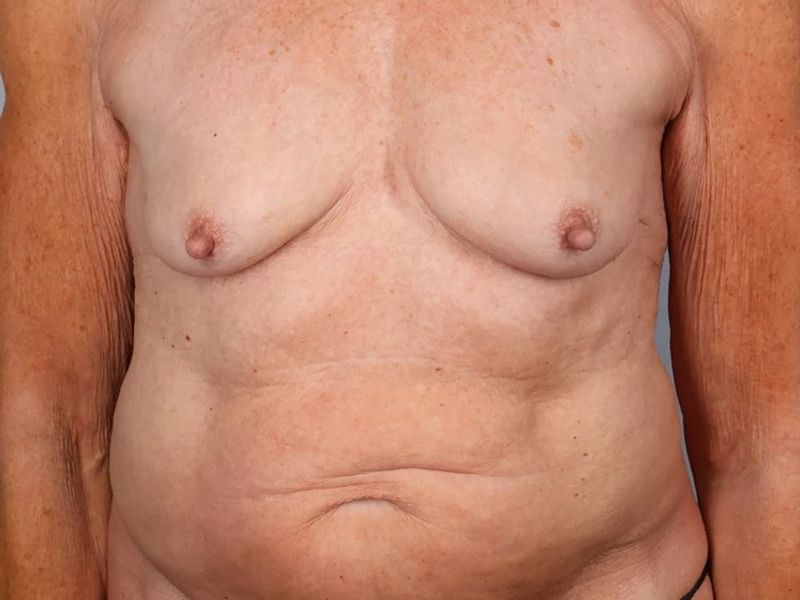 Before — Tummy Tuck (Abdominoplasty)