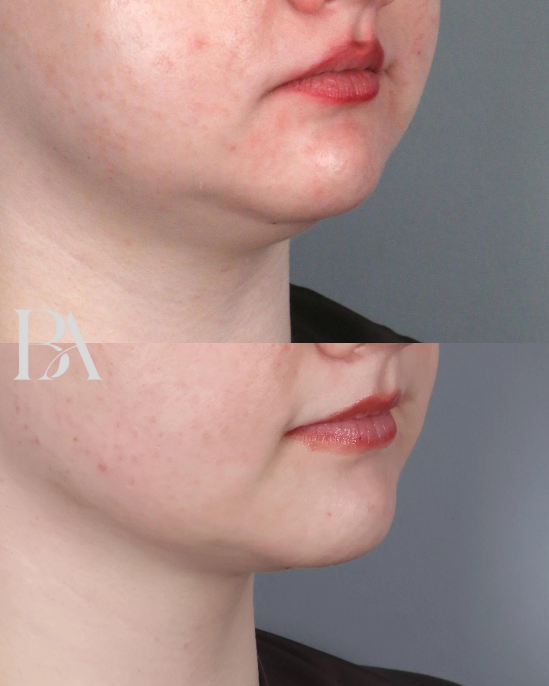 Submental Liposuction before and after — oblique view, Dr. Beina Azadgoli, Beverly Hills