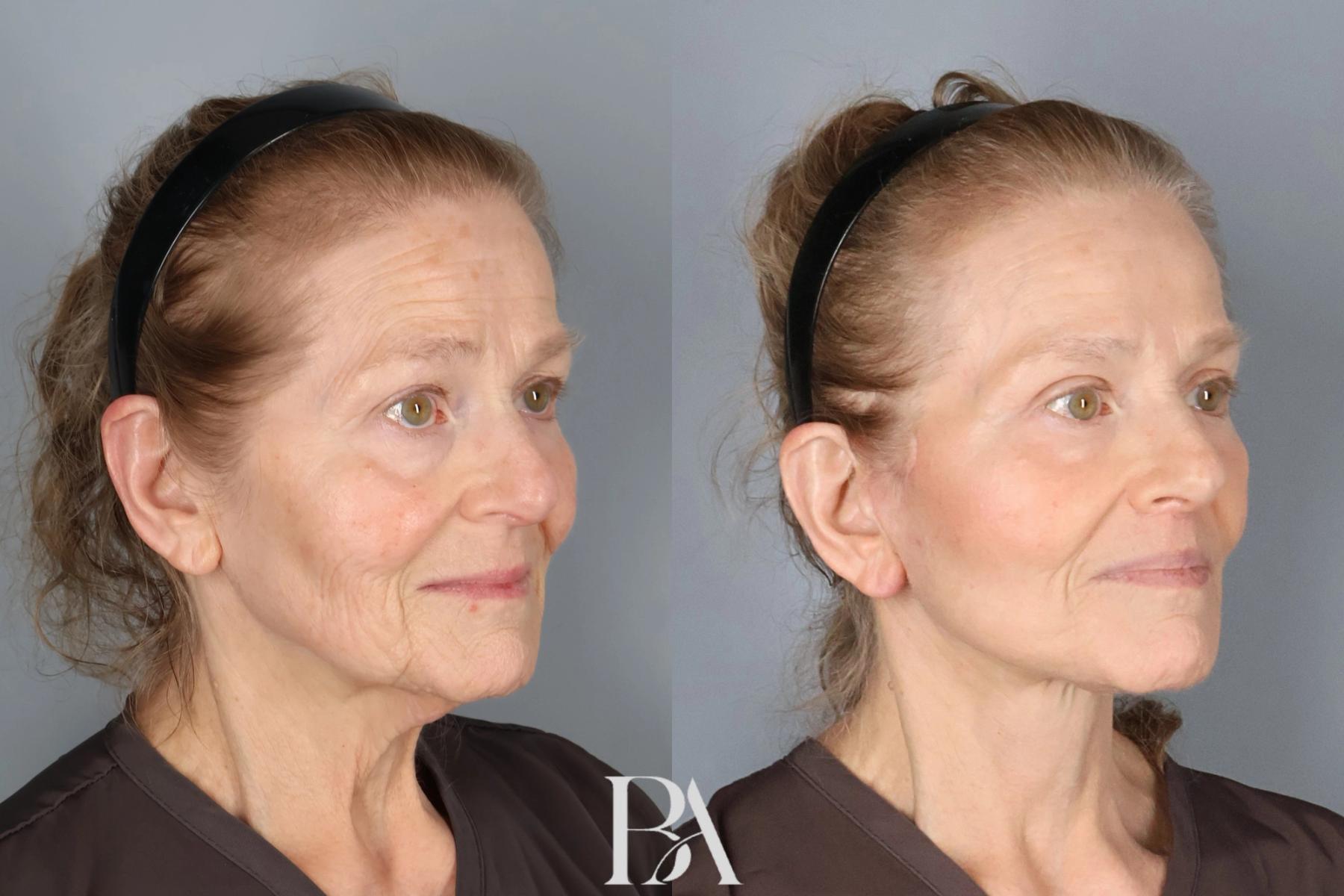 Face/Neck Lift before and after — oblique view, Dr. Beina Azadgoli, Beverly Hills
