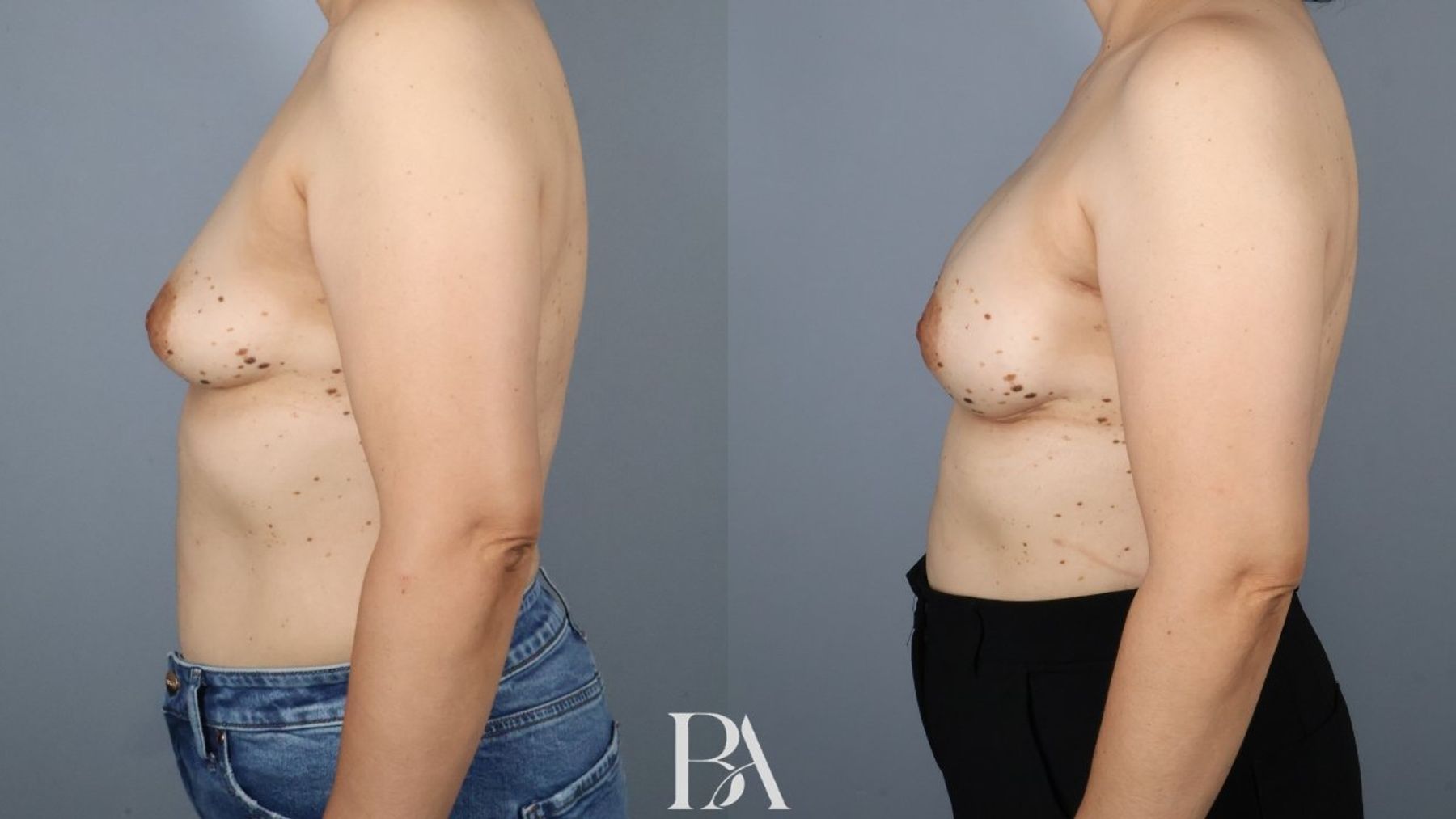 Direct-to-Implant Reconstruction before and after — three-quarter view, Dr. Beina Azadgoli, Beverly Hills