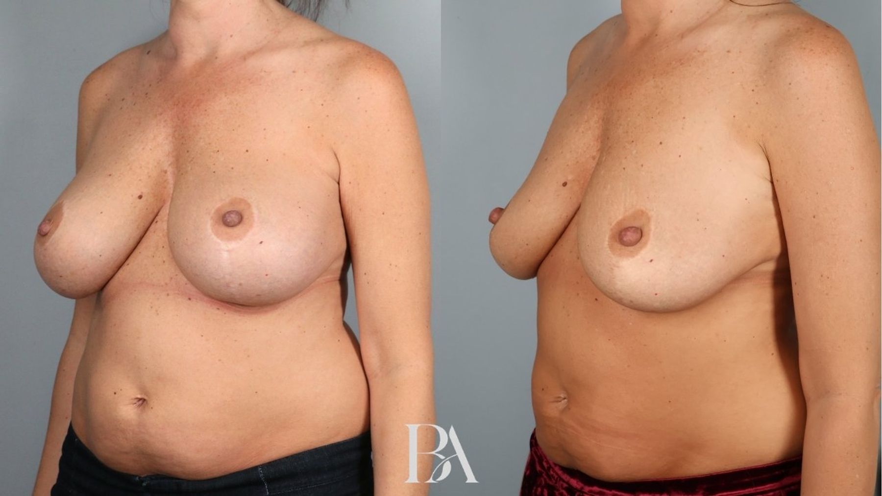 Breast implant removal before and after — three-quarter view, Dr. Beina Azadgoli, Beverly Hills