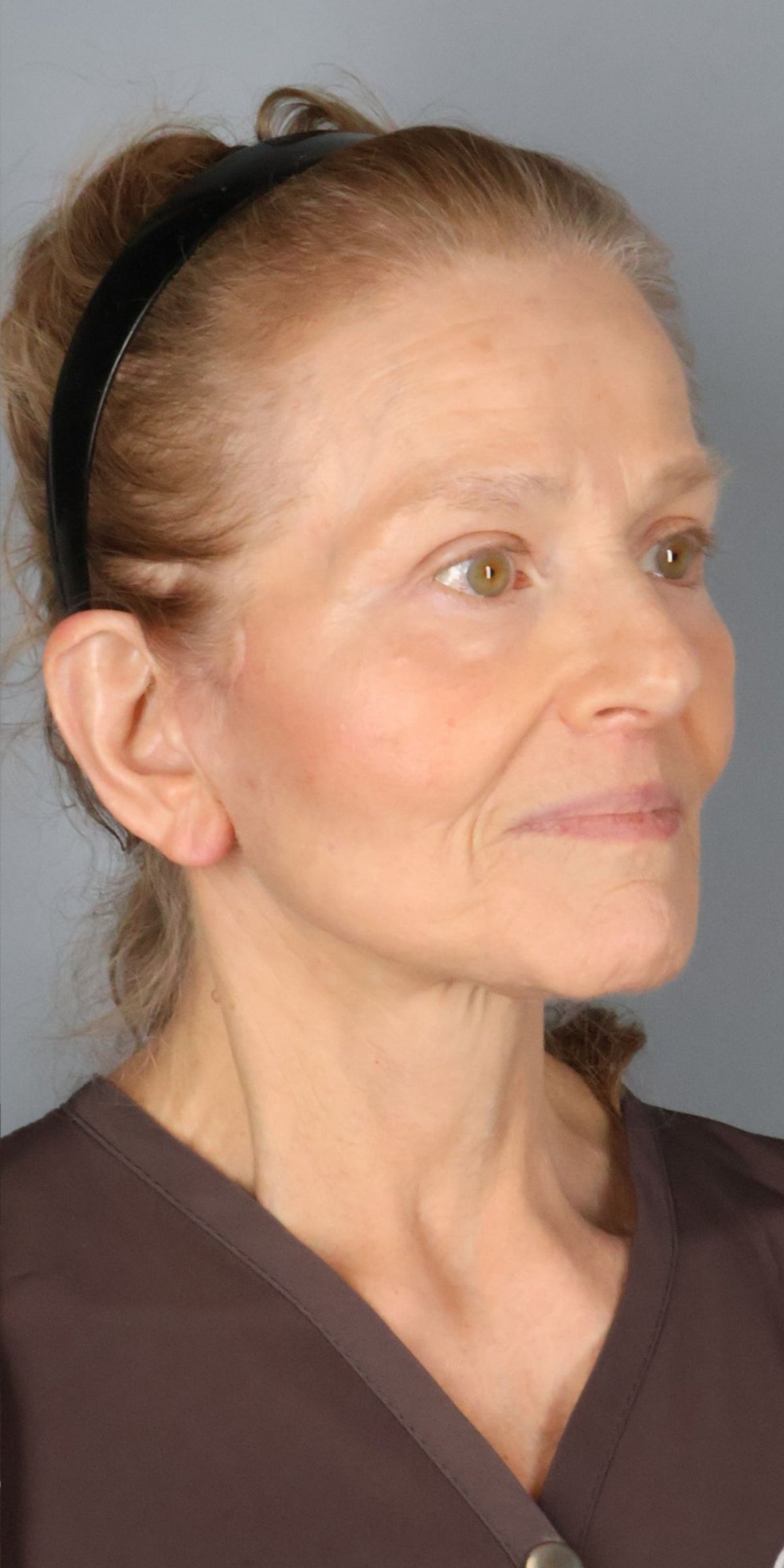 Face/neck lift after — oblique view, Dr. Beina Azadgoli, Beverly Hills