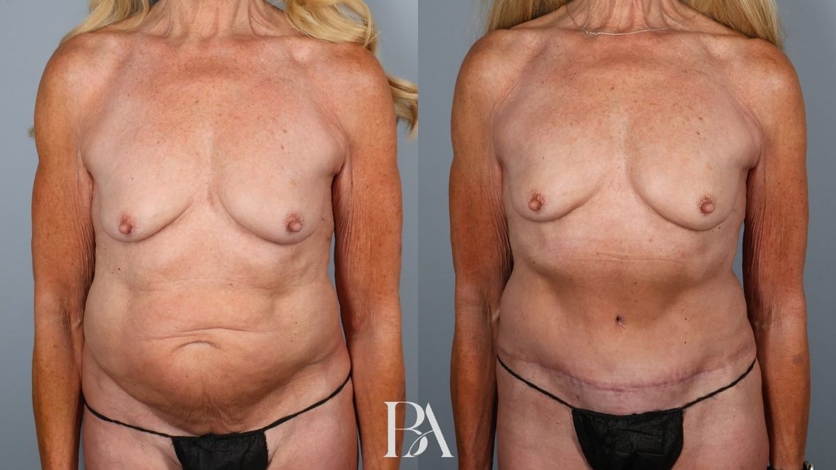 Before and after — Tummy Tuck (Abdominoplasty)