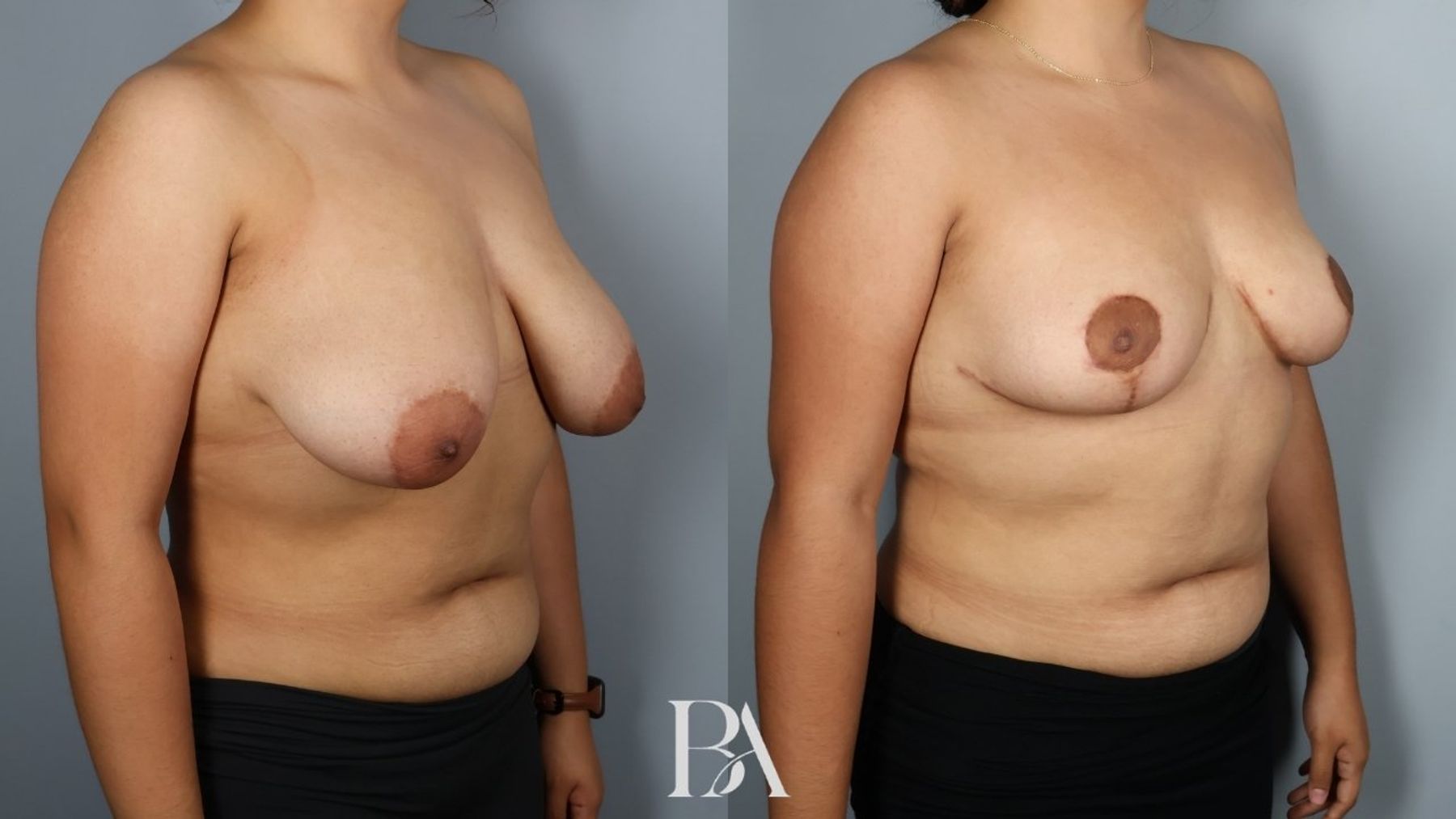 Breast reduction before and after — oblique view, Dr. Beina Azadgoli, Beverly Hills