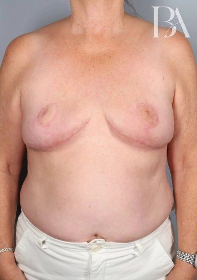 After — SWIM Flap Reconstruction