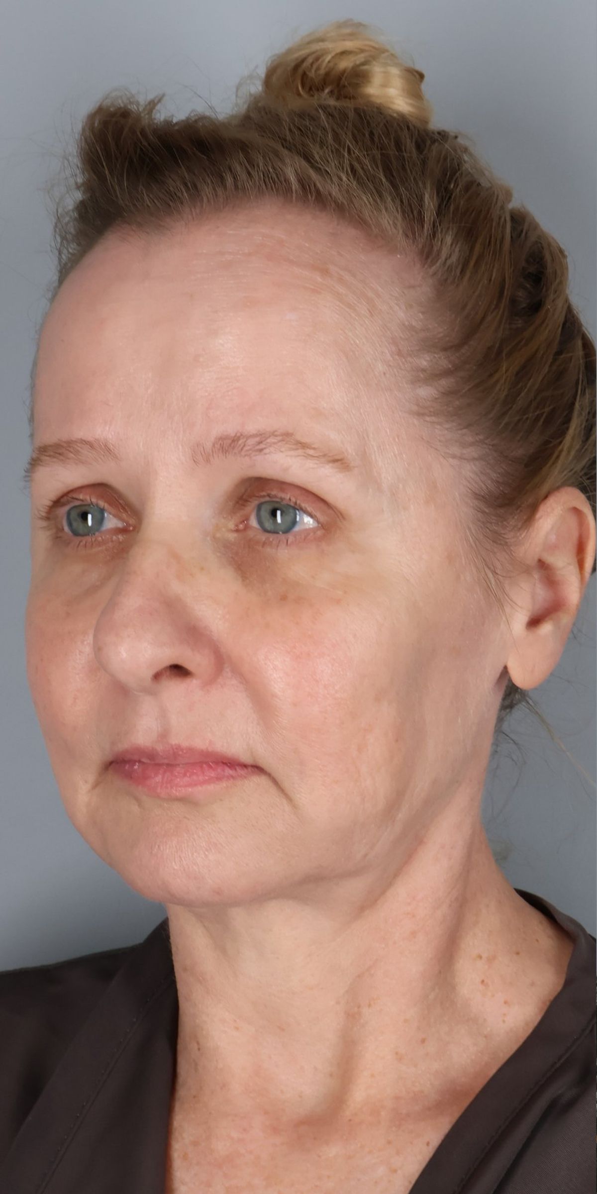 Face/neck lift before — three-quarter view, Dr. Beina Azadgoli, Beverly Hills