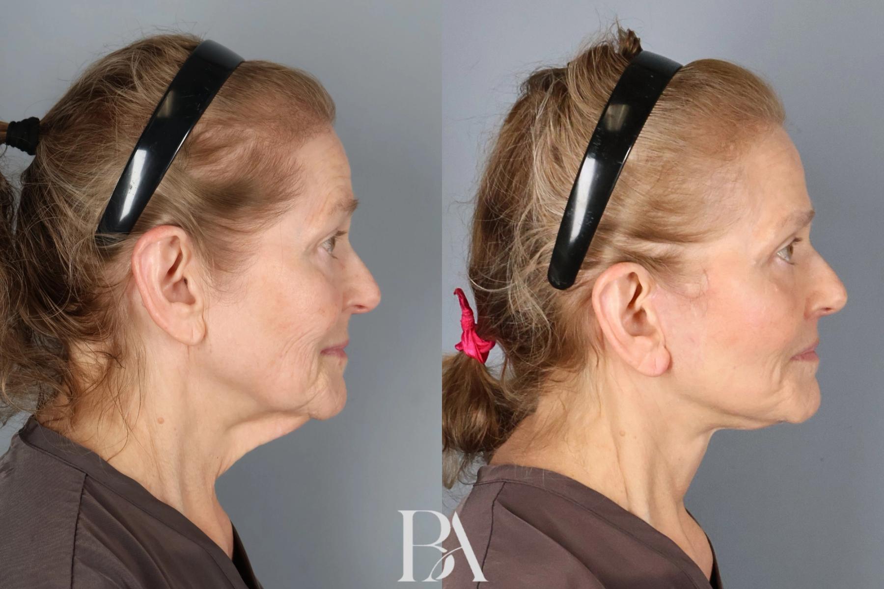 Face/Neck Lift before and after — side view, Dr. Beina Azadgoli, Beverly Hills