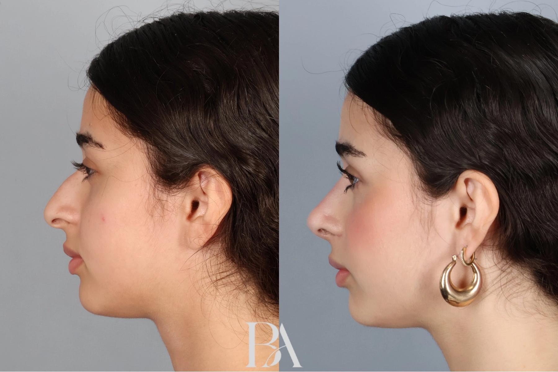 Rhinoplasty before and after — side view, Dr. Beina Azadgoli, Beverly Hills