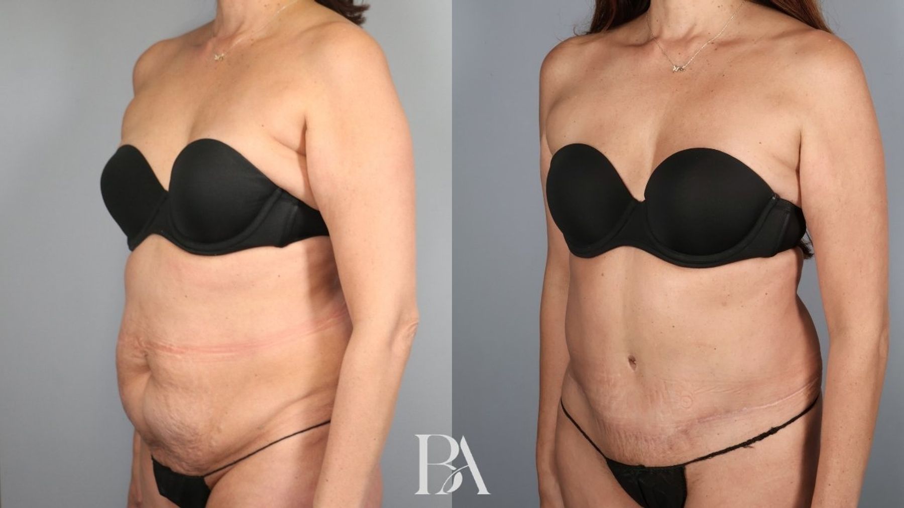 Tummy tuck before and after — three-quarter view, Dr. Beina Azadgoli, Beverly Hills