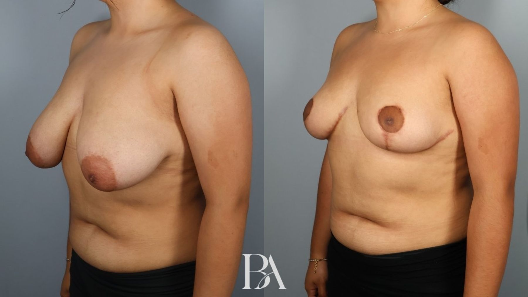 Breast reduction before and after — three-quarter view, Dr. Beina Azadgoli, Beverly Hills