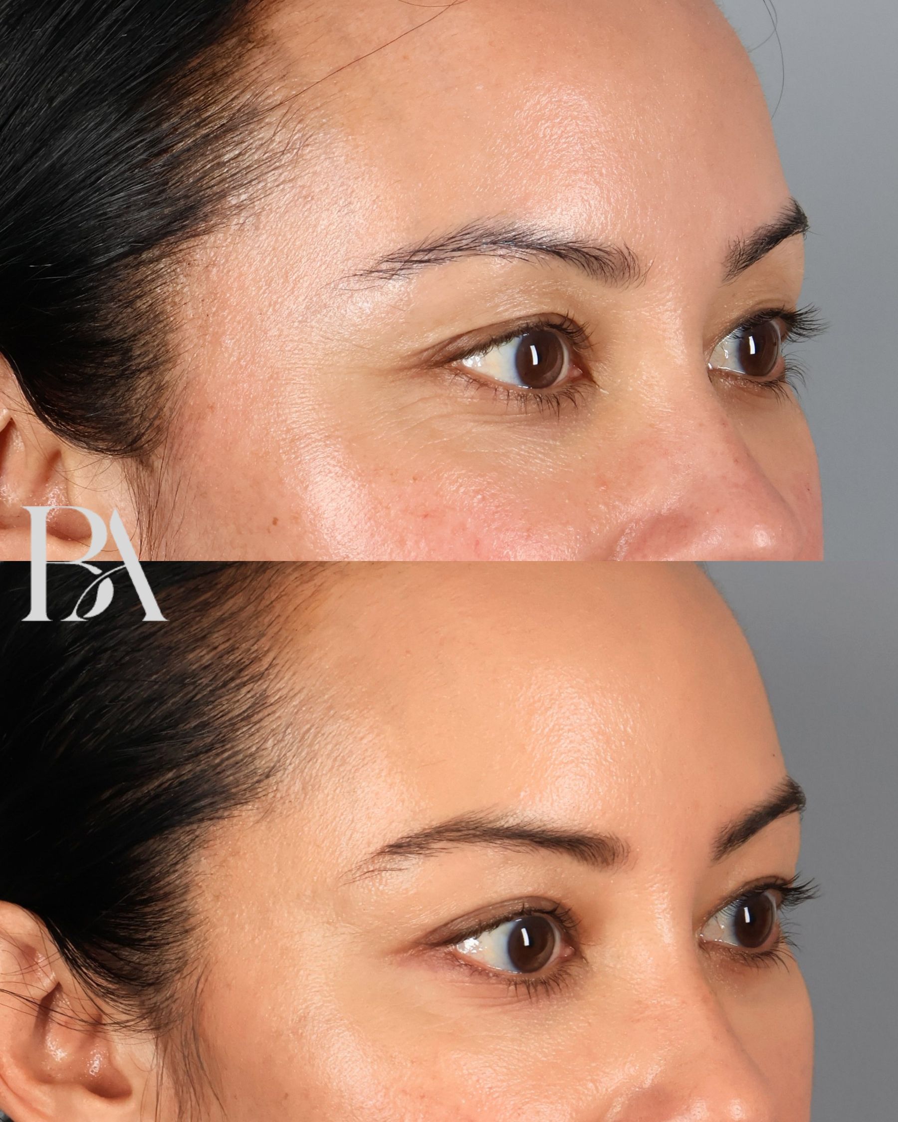 Upper Blepharoplasty before and after — oblique view, Dr. Beina Azadgoli, Beverly Hills