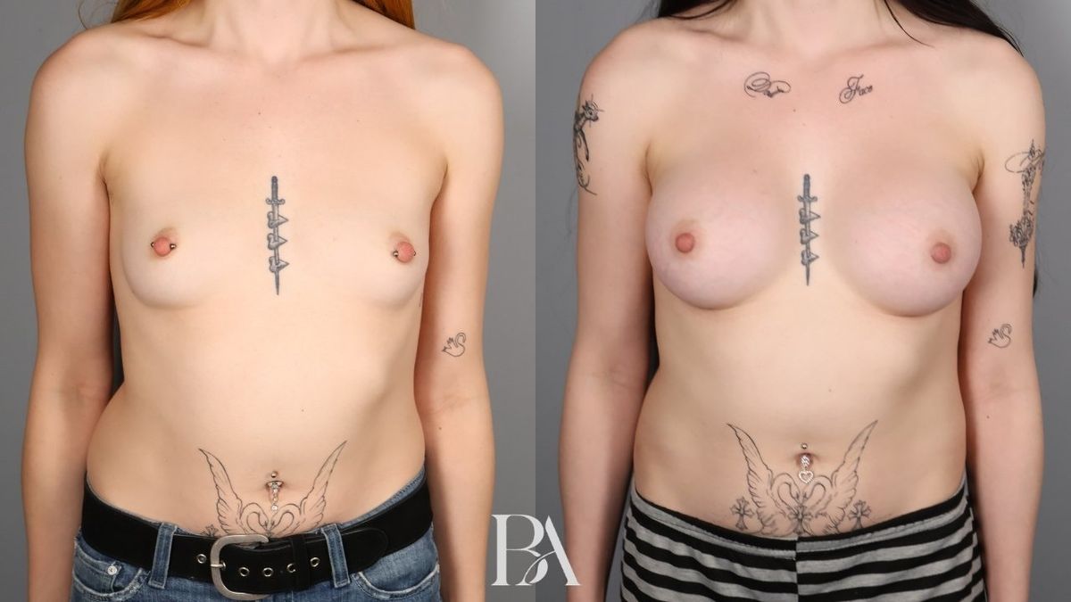 Before and after — Breast Augmentation