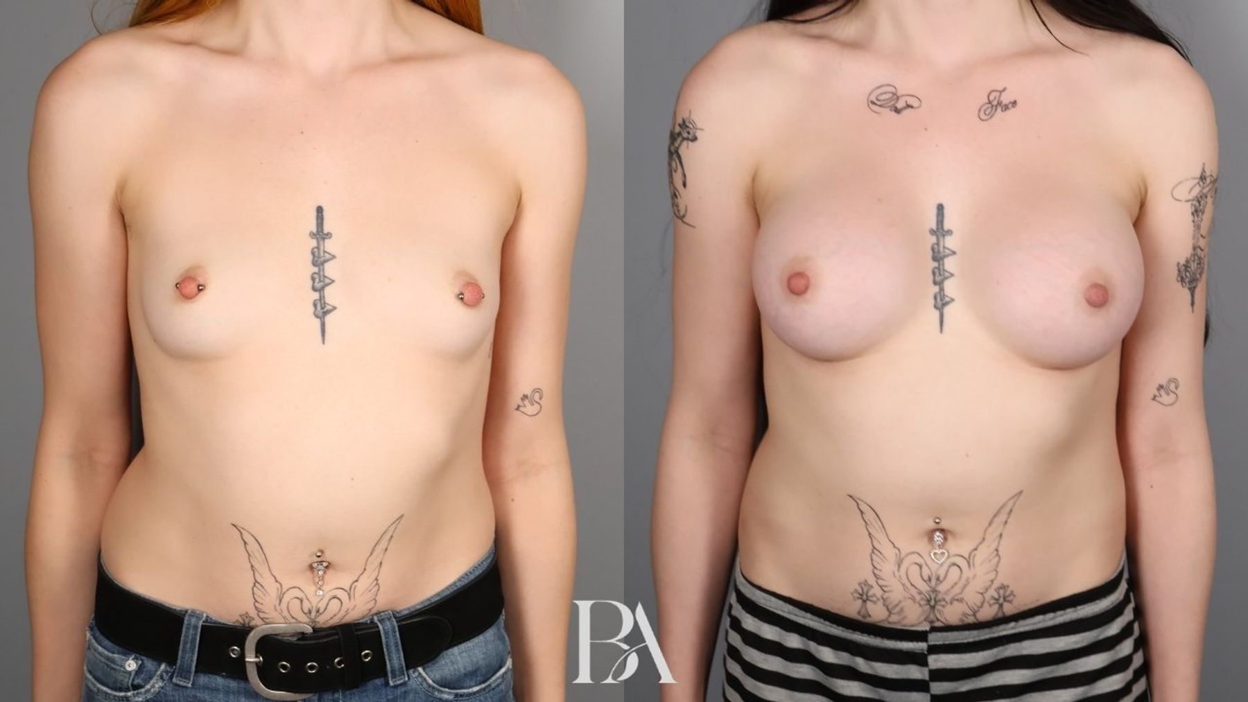 Breast augmentation before and after — front view, Dr. Beina Azadgoli, Beverly Hills