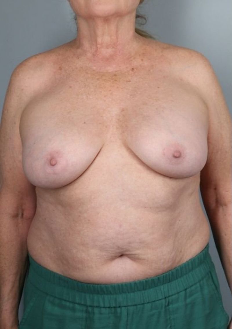 Before — Breast Implant Removal (+/- Lift)
