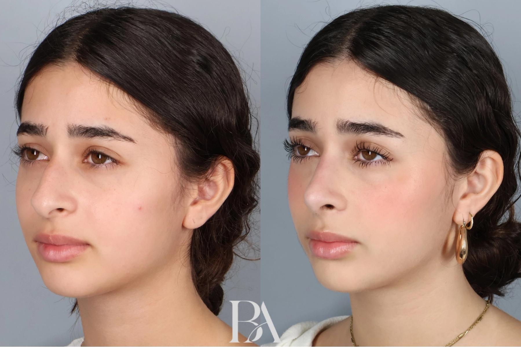 Rhinoplasty before and after — three-quarter view, Dr. Beina Azadgoli, Beverly Hills