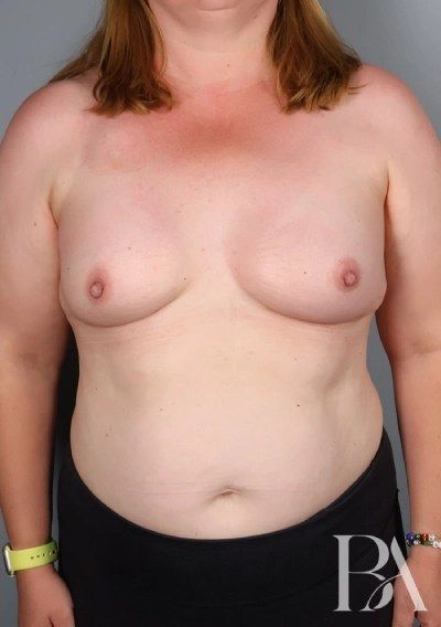 After — Direct-to-Implant Reconstruction