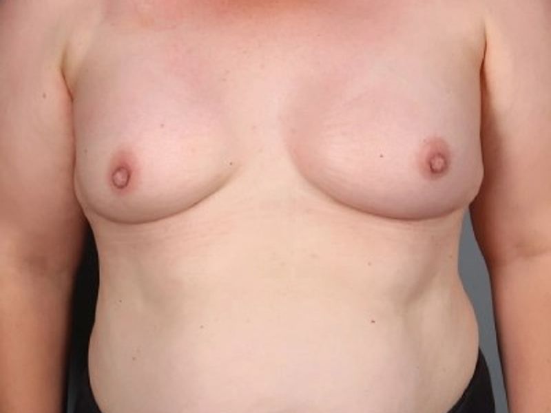 After — Direct-to-Implant Reconstruction