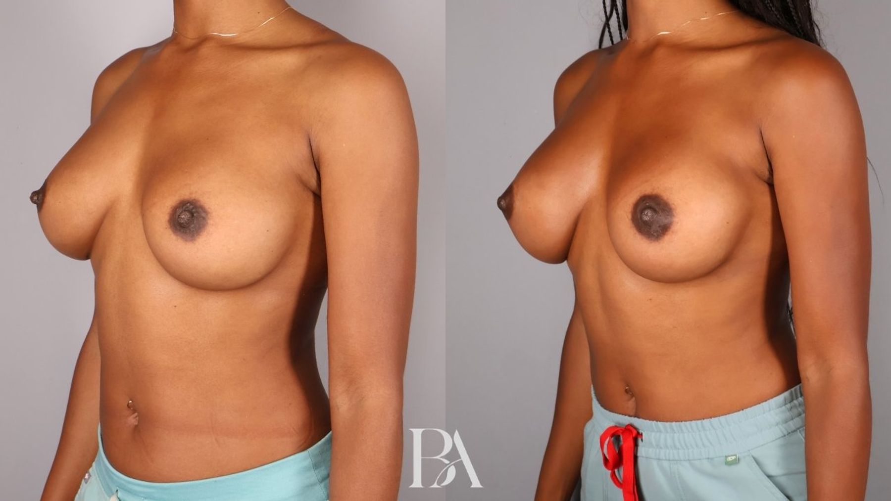 Implant Removal and Replacement before and after — three-quarter view, Dr. Beina Azadgoli, Beverly Hills