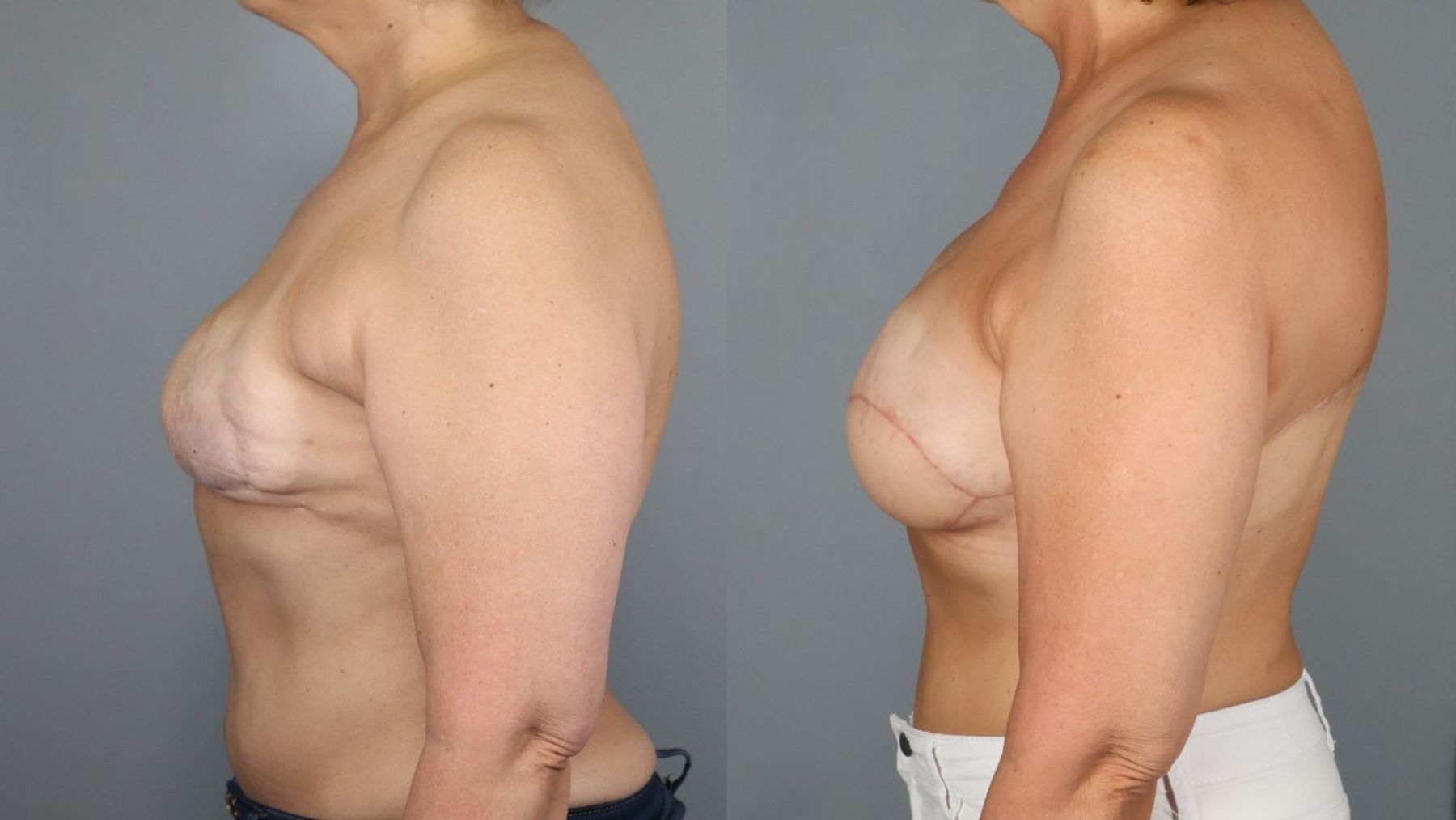 Breast Reconstruction Revision before and after — side view, Dr. Beina Azadgoli, Beverly Hills