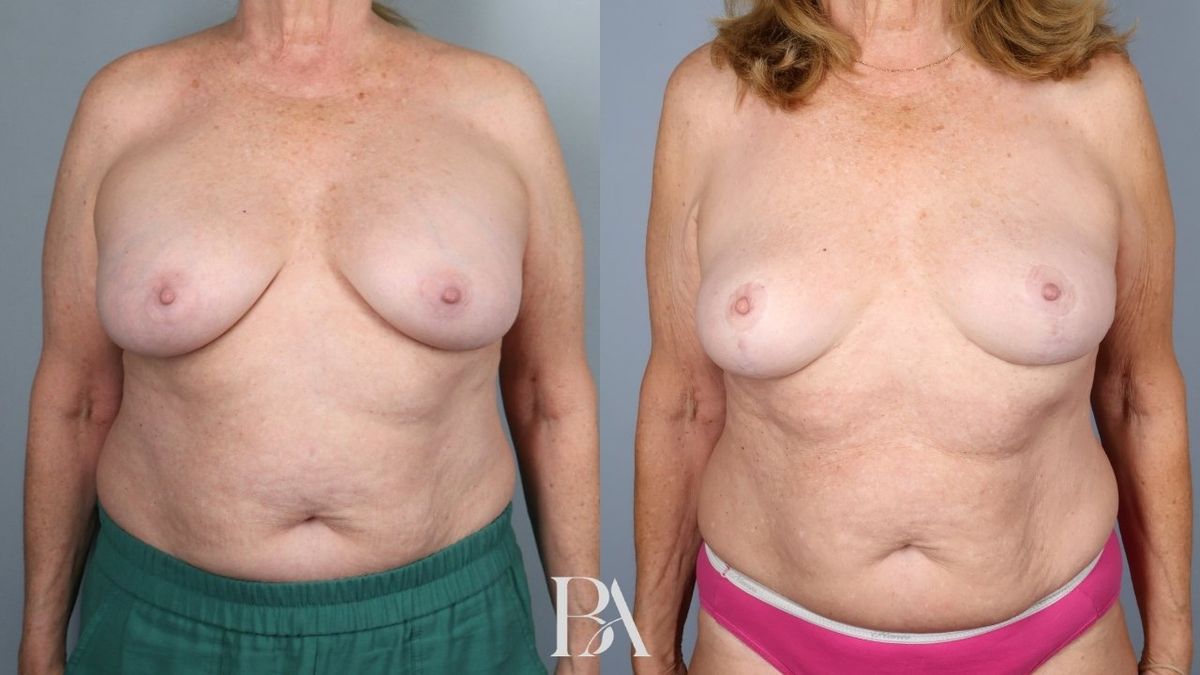 Before and after — Breast Implant Removal (+/- Lift)