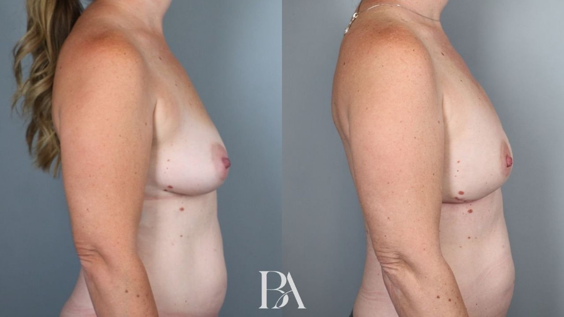 Direct-to-Implant Reconstruction before and after — side view, Dr. Beina Azadgoli, Beverly Hills