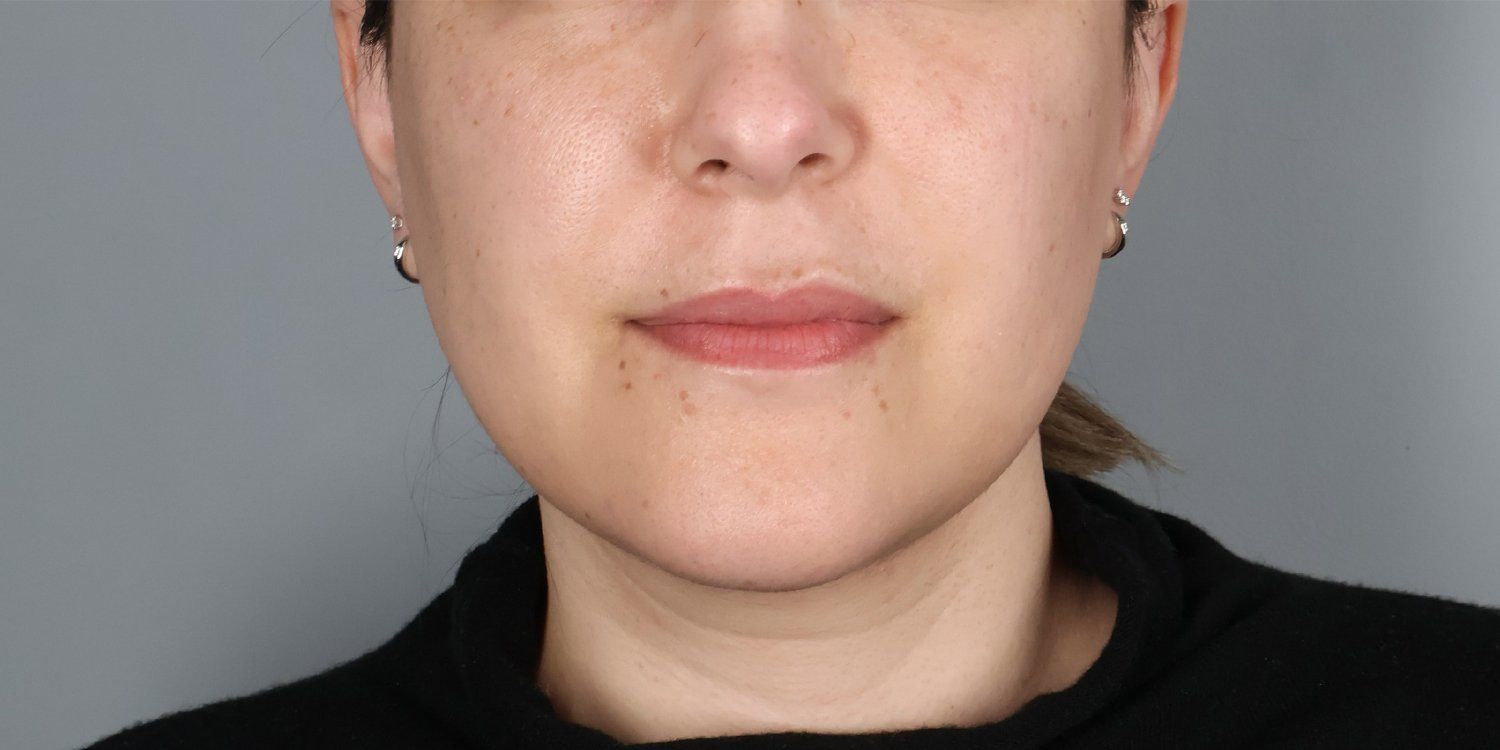 After — Submental Liposuction