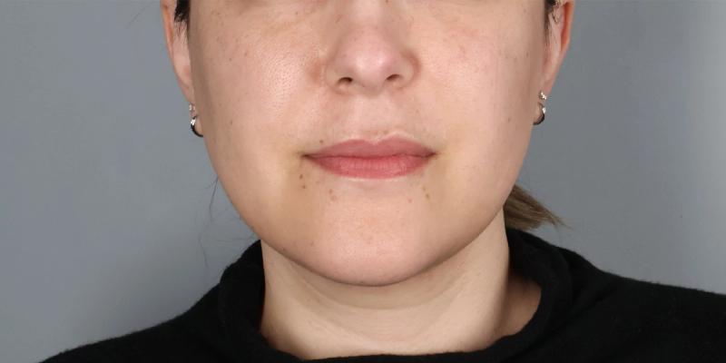 After — Submental Liposuction