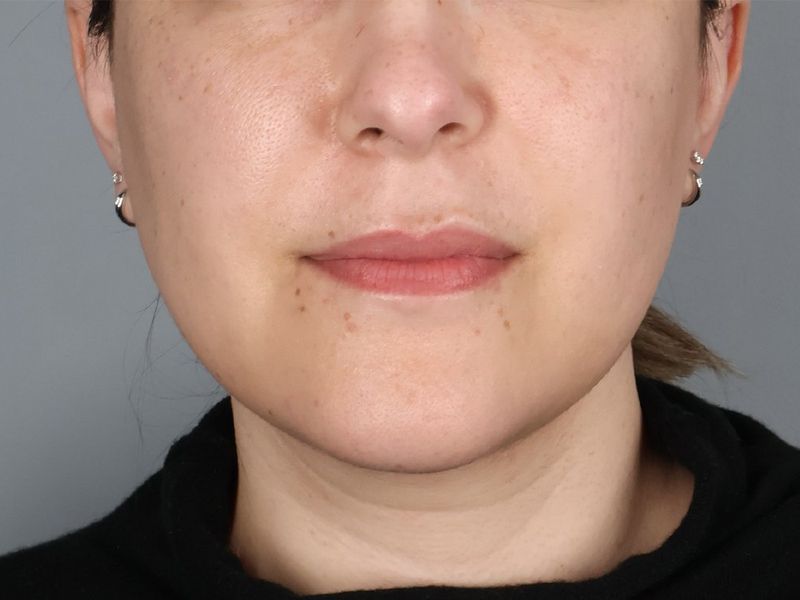 After — Submental Liposuction