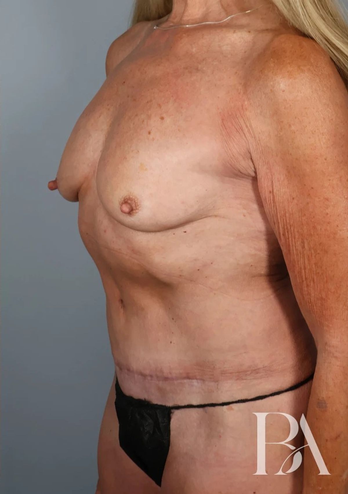 Case 5001 — Oblique after