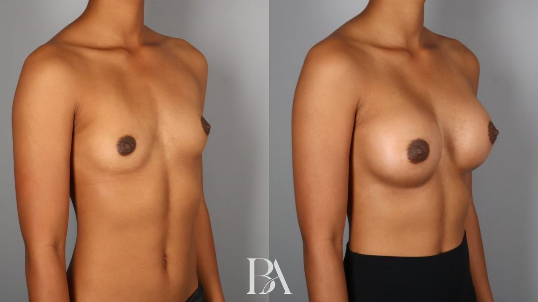 Breast augmentation before and after — oblique view, Dr. Beina Azadgoli, Beverly Hills