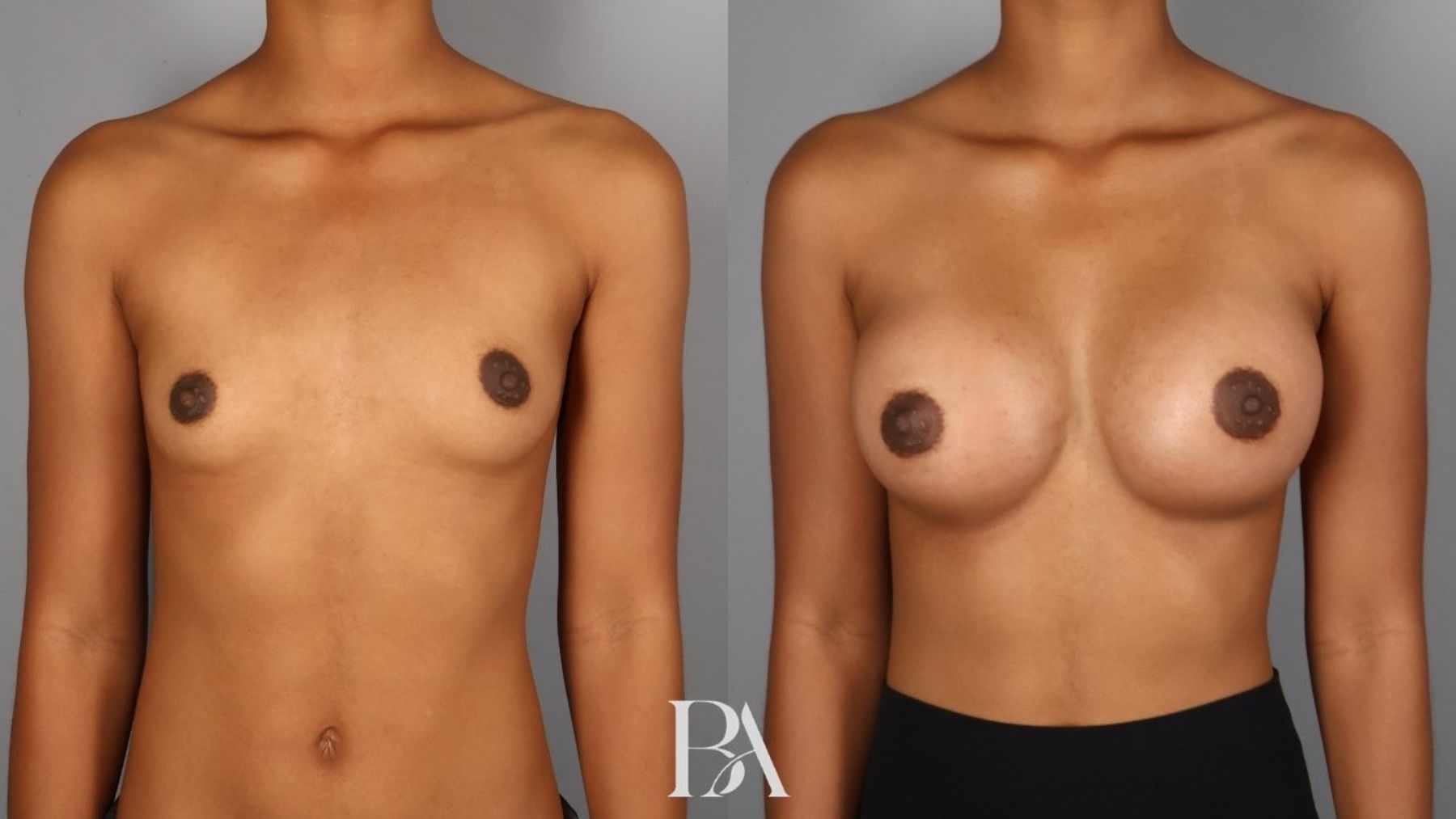 Breast augmentation before and after — front view, Dr. Beina Azadgoli, Beverly Hills