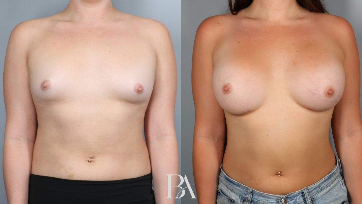Before and after — Breast Augmentation