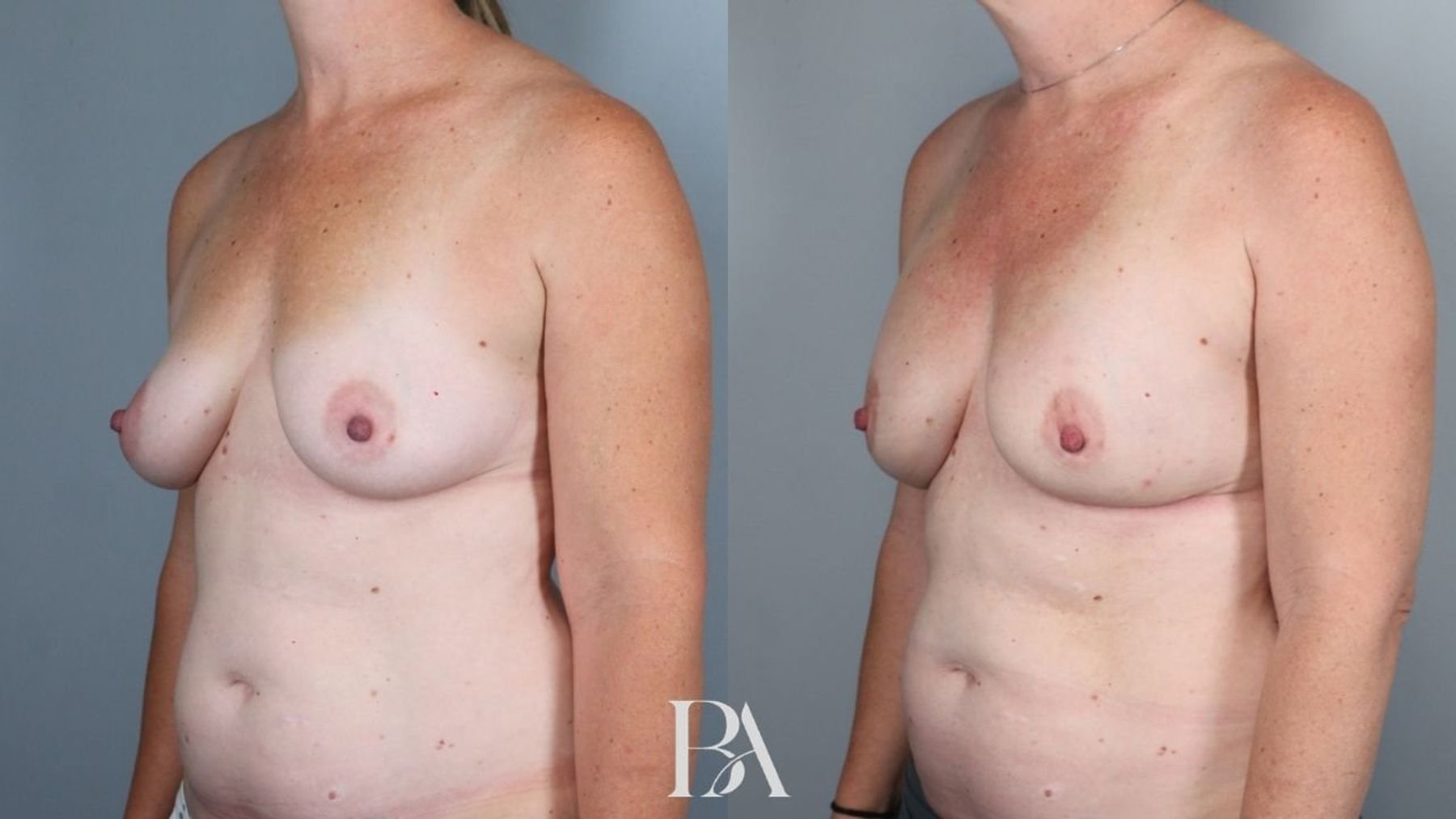 Direct-to-Implant Reconstruction before and after — three-quarter view, Dr. Beina Azadgoli, Beverly Hills
