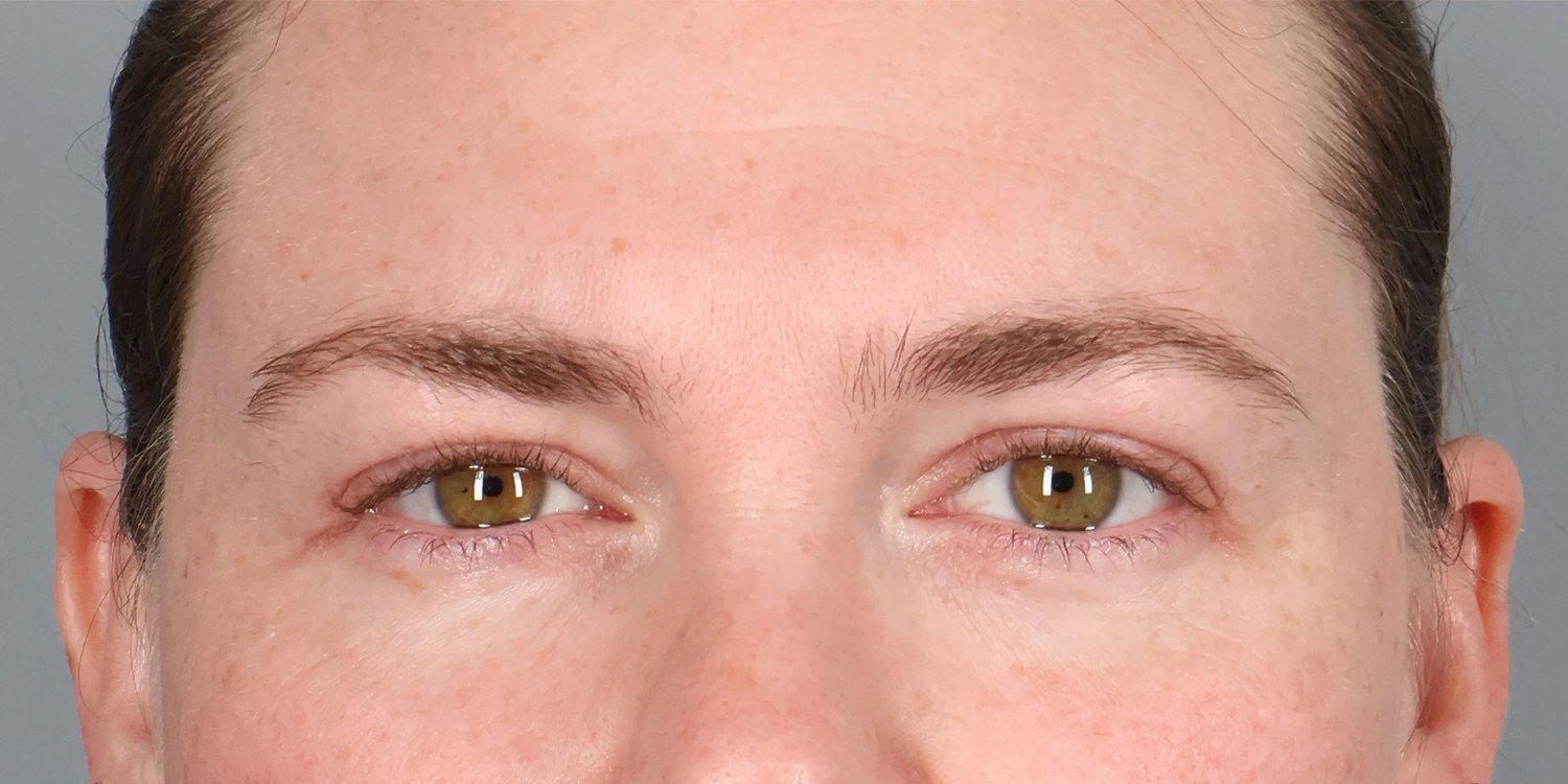 After — Upper Blepharoplasty