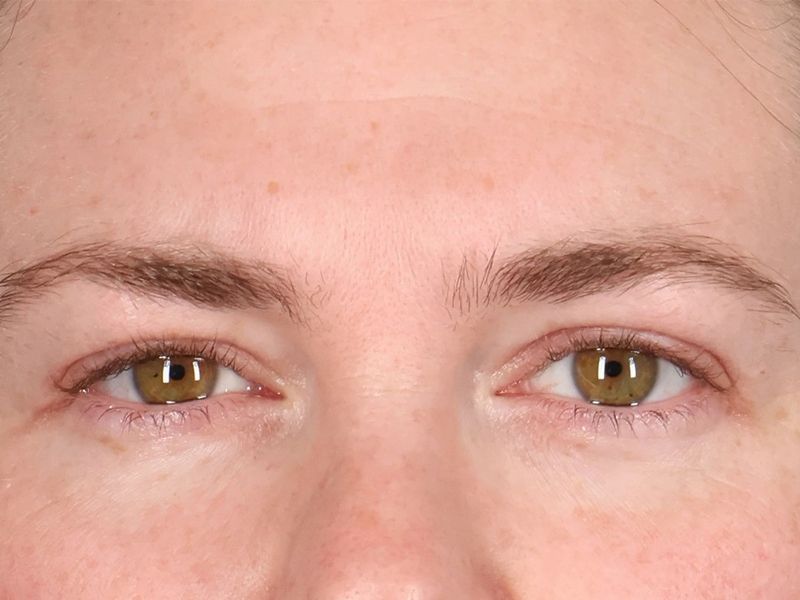 After — Upper Blepharoplasty