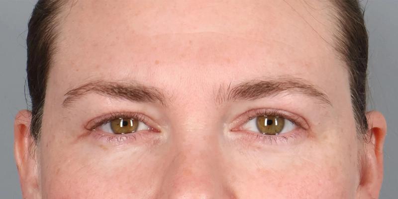 After — Upper Blepharoplasty