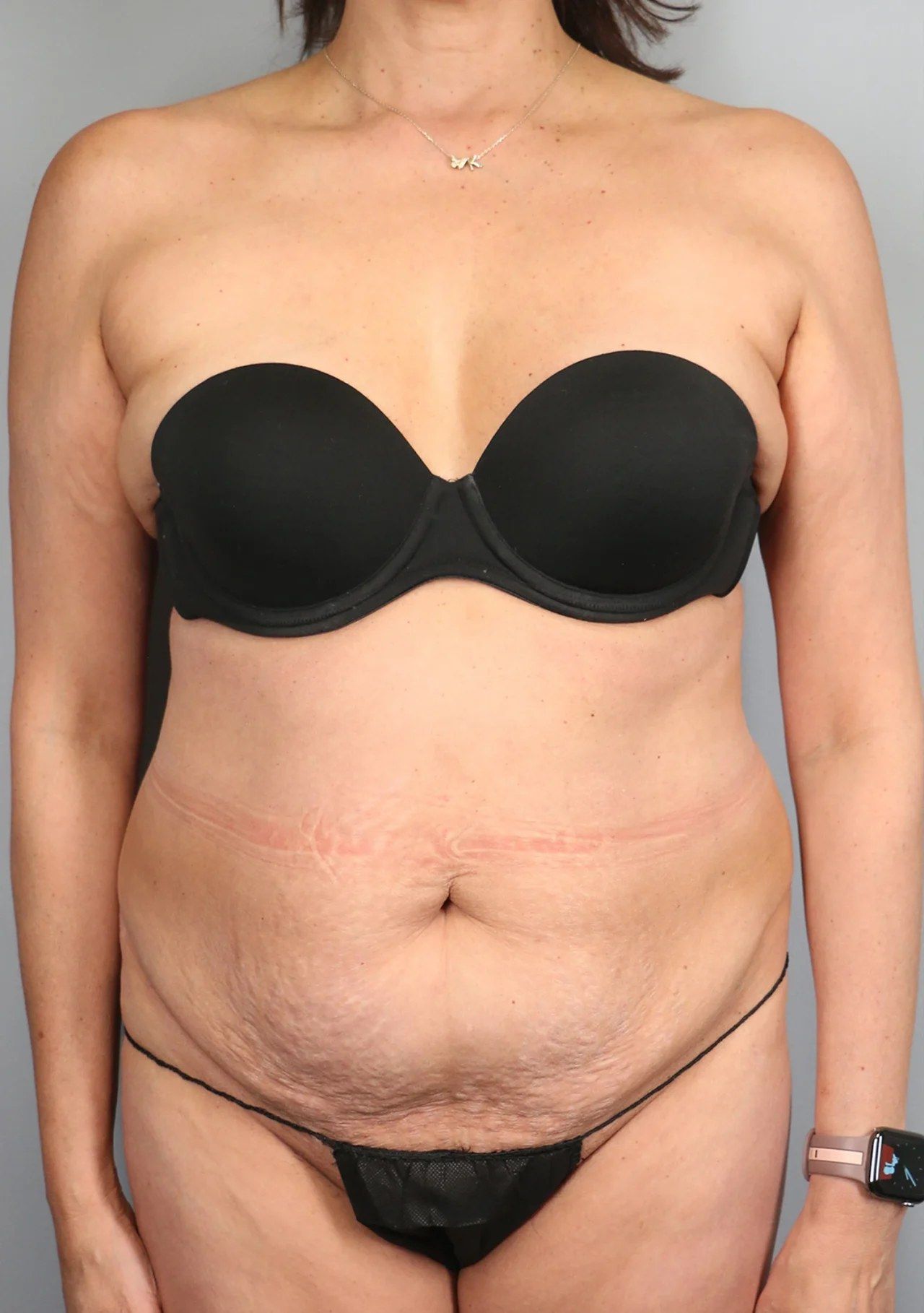 Before — Tummy Tuck (Abdominoplasty)