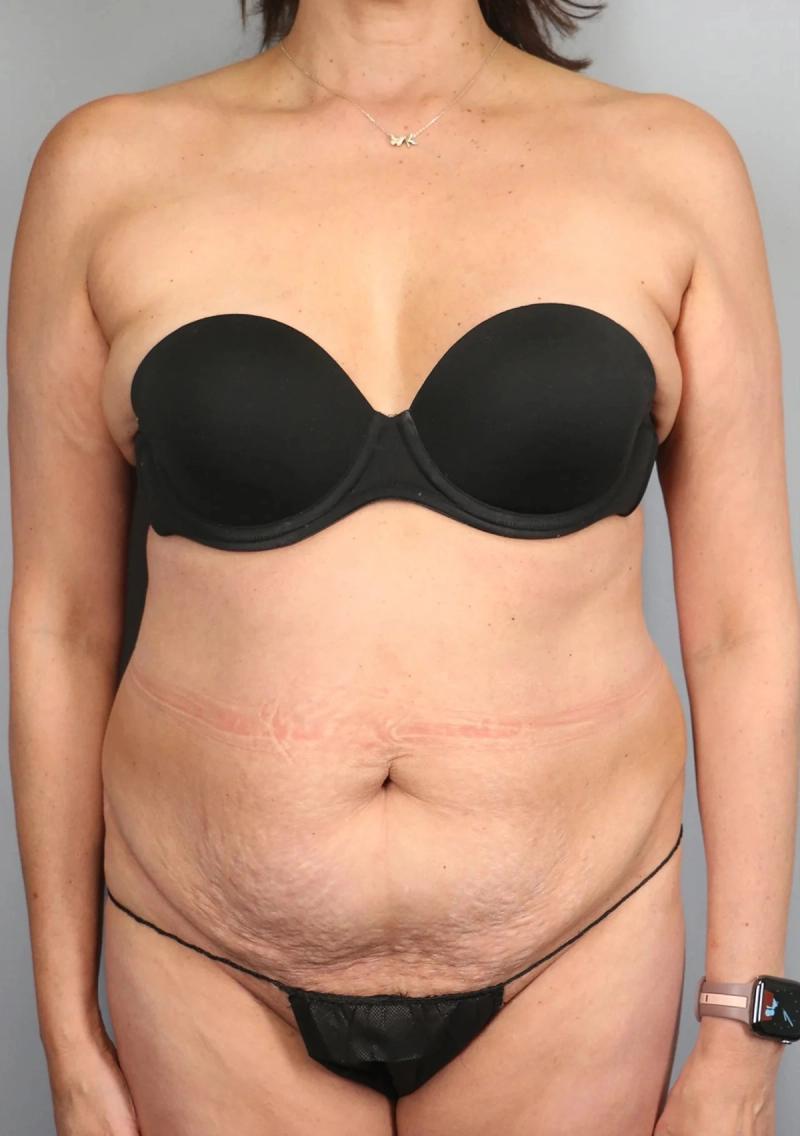 Before — Tummy Tuck (Abdominoplasty)
