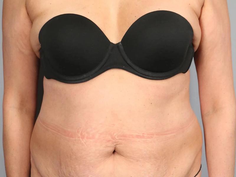 Before — Tummy Tuck (Abdominoplasty)